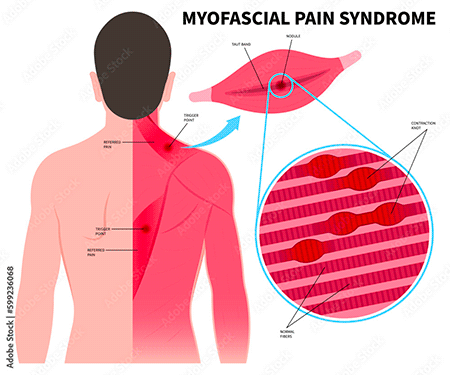 fascia musculaire